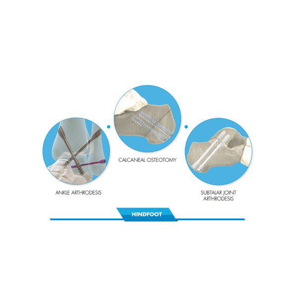 Hindfoot indications